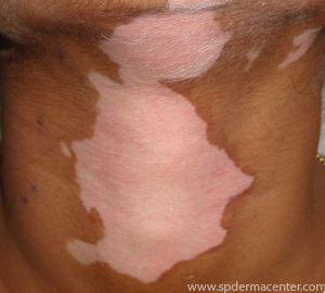 Vitiligo-Before